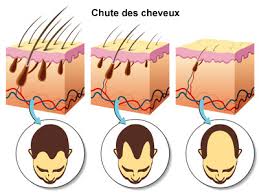 La chute et la perte des cheveux