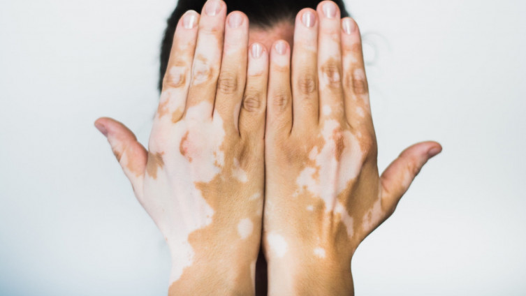 Vitiligo (dépigmentation de l’épiderme) : Causes, Symptômes et Traitement !!