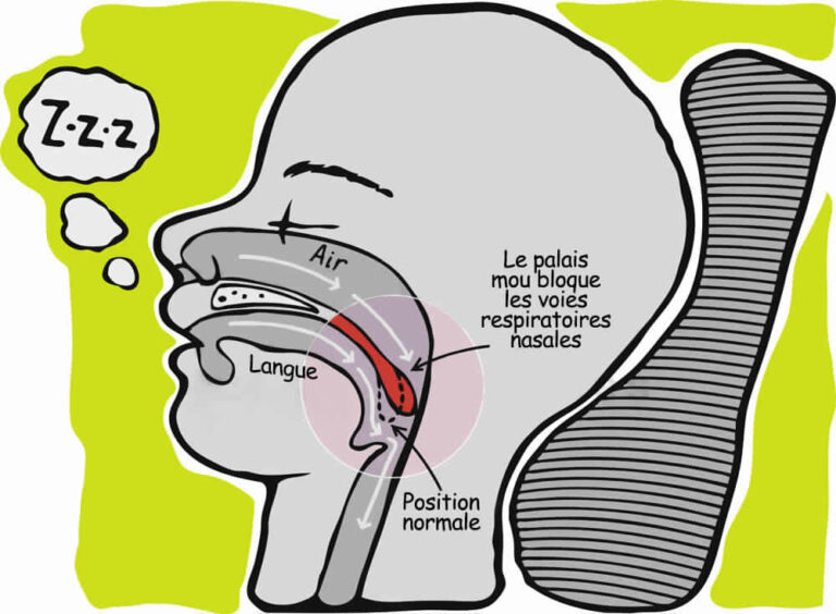 Comment arrêter de ronfler