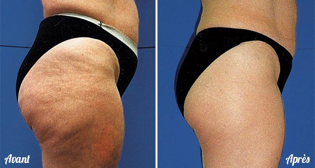 Cette épice vous aidera à vous débarrasser de la cellulite