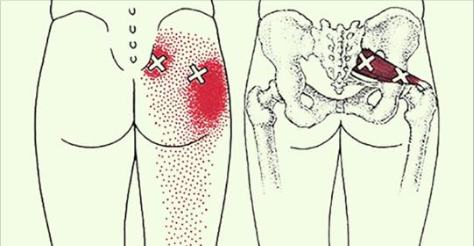 4 exercices sûrs et efficaces pour soulager la douleur du bas du dos