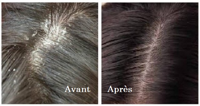 Traitement contre la perte de cheveux et les pellicules…