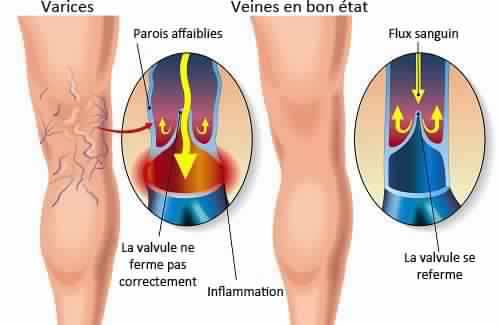 Solution efficace Contre Les Varices A La Maison