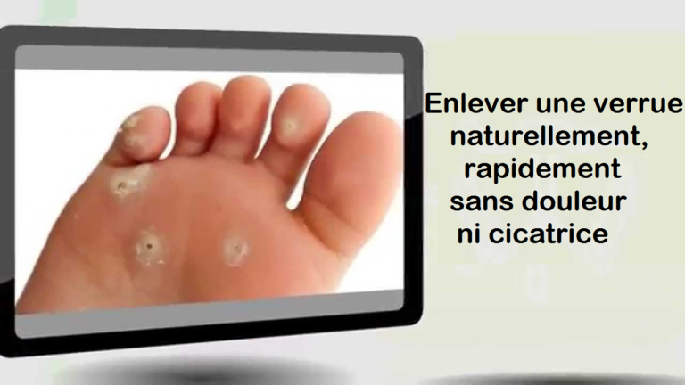 Comment enlever une verrue naturellement, rapidement sans douleur ni cicatrice