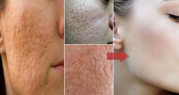 Comment réduire l’apparence des pores : des solutions douces à essayer chez soi