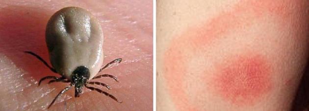 Bien connaitre la maladie de Lyme : de plus en plus fréquente