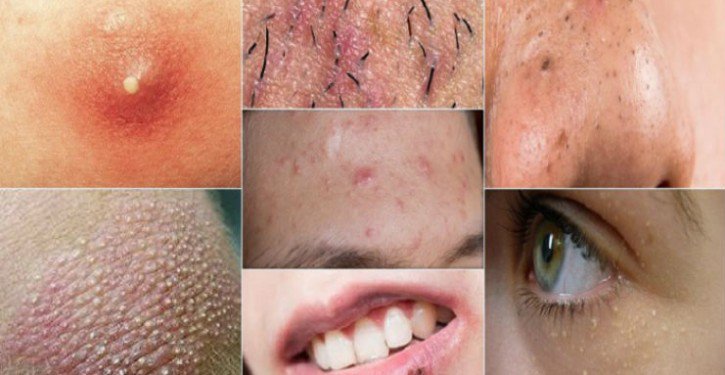 2 types de boutons sur le visage qu’il vaut mieux éviter de percer