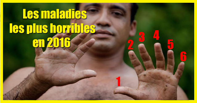 Top 6 des maladies les plus horribles en 2016