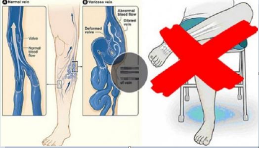 Pourquoi Vous Devriez Arrêter de Croiser les Jambes : 5 Raisons qui Vont Vous Convaincre »