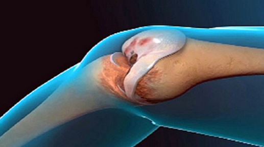 Remède Naturel pour Soulager les Douleurs Articulaires des Genoux et des Pieds