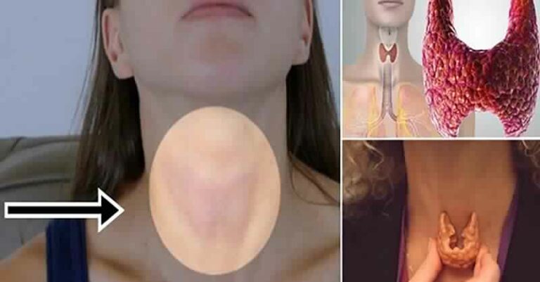 Remède Naturel pour Équilibrer Votre Thyroïde : Recette et Mode d’Emploi