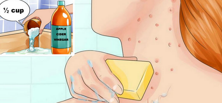 Conseils naturels pour traiter l’acné et l’eczéma avec du vinaigre de cidre