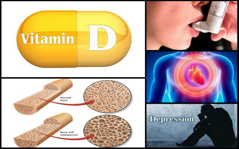 La Vitamine D : Un Élément Clé pour la Santé Quotidienne et la Prévention de Maladies Graves