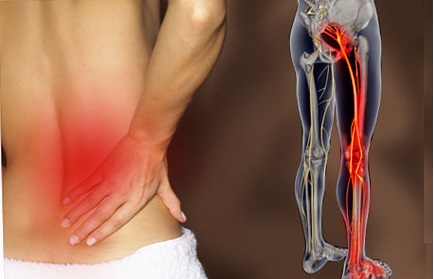 Comment soigner la douleur sciatique à la maison !