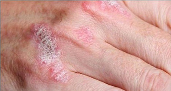 Soulager naturellement l’eczéma, le psoriasis, la dermatite, et les allergies de la peau