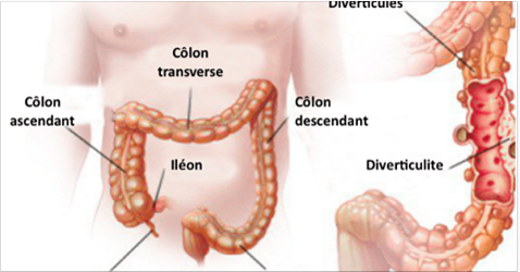 Que sont vraiment la diverticulose et la diverticulite, et comment les traiter?