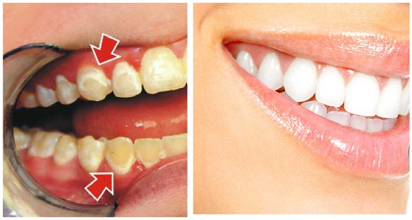 Comment enlever la plaque des dents en seulement 5 minutes !
