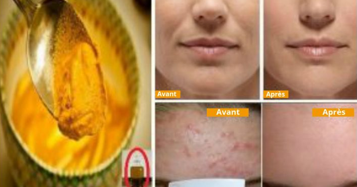 Masque Naturel au Curcuma pour une Peau Radieuse et Sans Imperfections