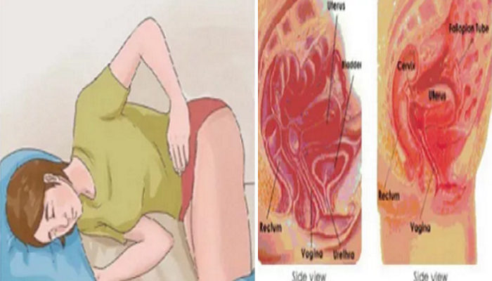 Comprendre l’Endométriose : Symptômes, Diagnostic et Signes à Surveiller