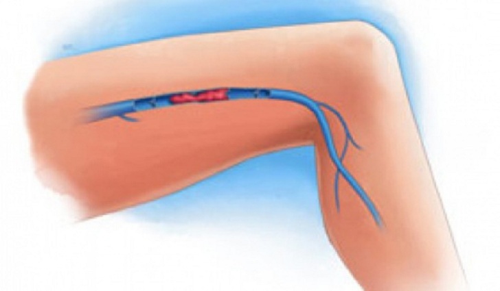 Important à Savoir : Symptômes et remèdes d’une thrombose veineuse dans les jambes …