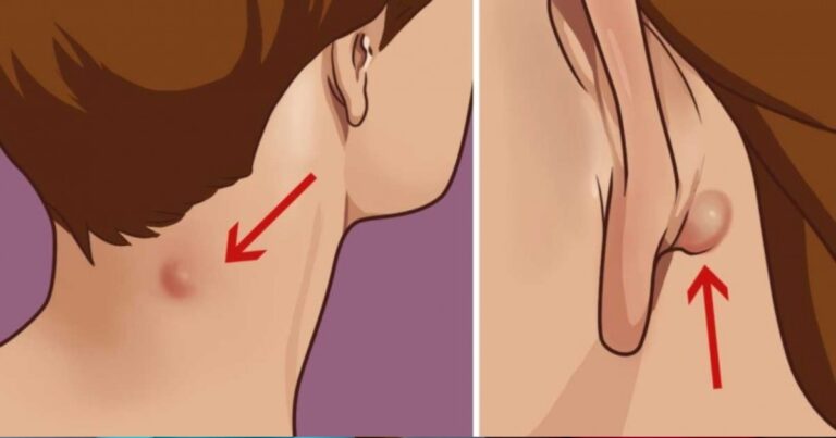Comment Traiter Naturellement une Enflure dans le Cou ou Derrière l’Oreille ?