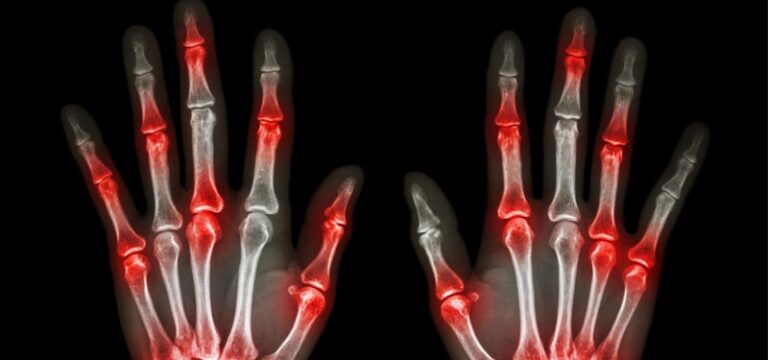 3 exercices pour toute personne souffrant d’arthrite