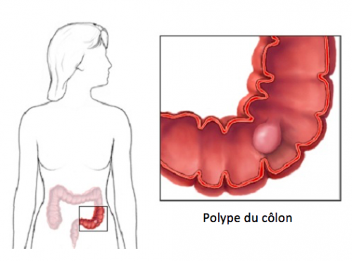 Les Symptômes de la Présence de Polypes au Colon à ne Pas Ignorer