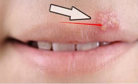 Remède de Grand-Mère pour soigner un bouton de fièvre naturellement