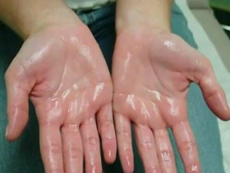 Comment limiter la transpiration au niveau des mains et des pieds …