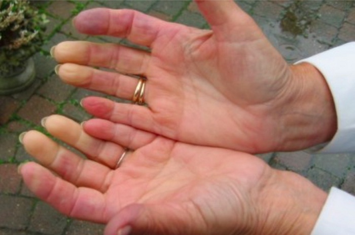 Remède naturel efficace pour traiter les symptômes du syndrome de Raynaud !