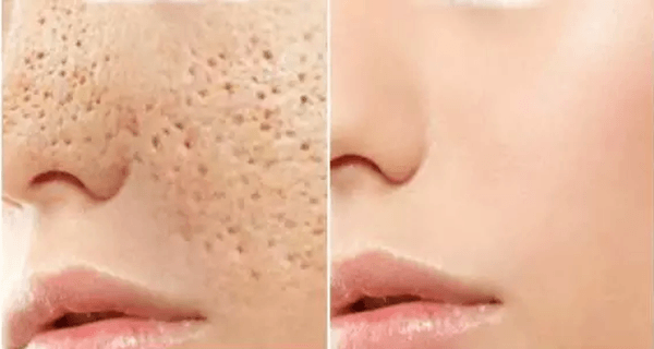 Comment faire disparaître rapidement les pores dilatés en 3 jours