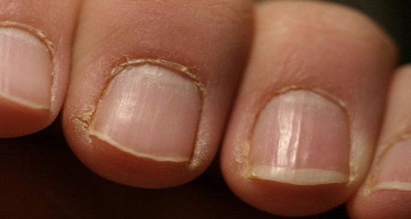 Leuchonychie : Ces Taches Blanches sur les Ongles ne Sont Pas un Manque de Calcium !