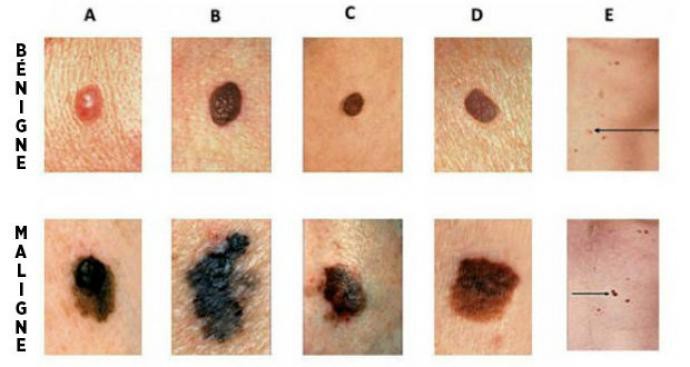 Comment reconnaître les premiers signes d’un cancer de la peau ?