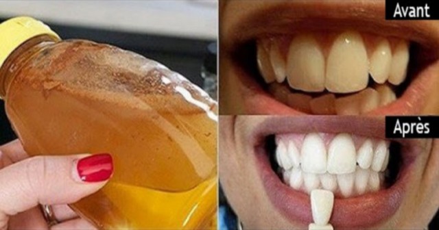Une méthode rapide et efficace pour nettoyer les dents