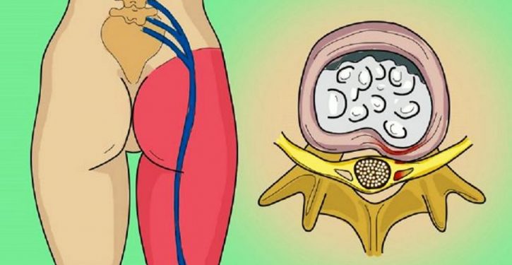 Une crise du nerf sciatique? Ce simple exercice d’une minute vous débarrasse de la douleur de la sciatique!