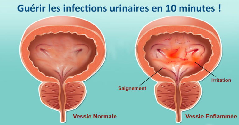 Voici comment guérir les infections urinaires en 10 minutes