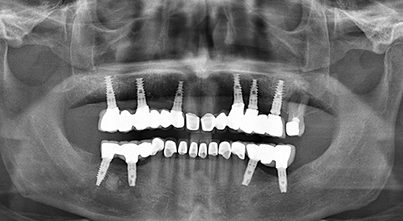 Dites Adieu aux implants dentaires, et faites pousser vos propres dents en seulement 9 semaines !