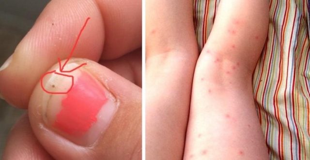 Elle remarque un point étrange sur l’ongle de sa fille, 1 jour plus tard, elle finit à l’hôpital !