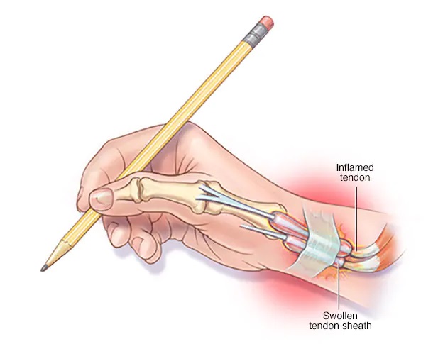La ténosynovite : l’inflammation des mains et des pieds à connaître