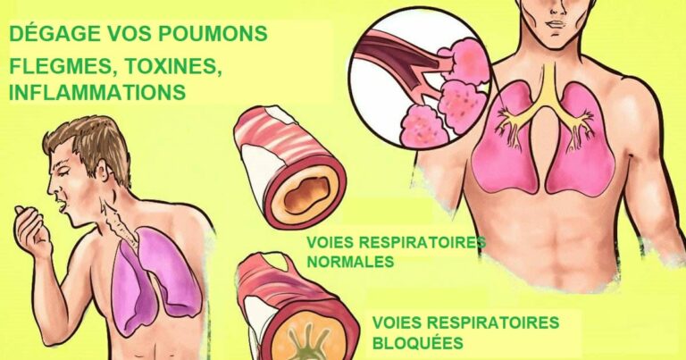Comment débarrasser vos poumons et votre gorge des flegmes persistants