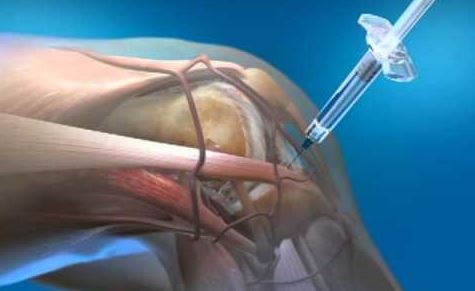 Arthrose : Les injections à base d’acide hyaluronique injectable du genou ne seront plus remboursés