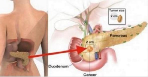 Evitez absolument de manger cet aliment, il cause le cancer du pancréas !!