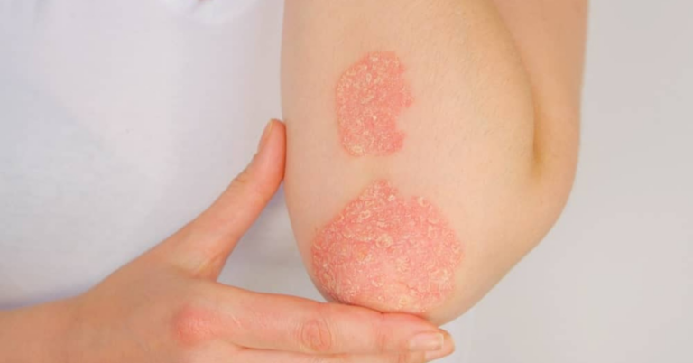 L’huile essentielle qui aide à soulager l’acné, l’eczéma et le psoriasis