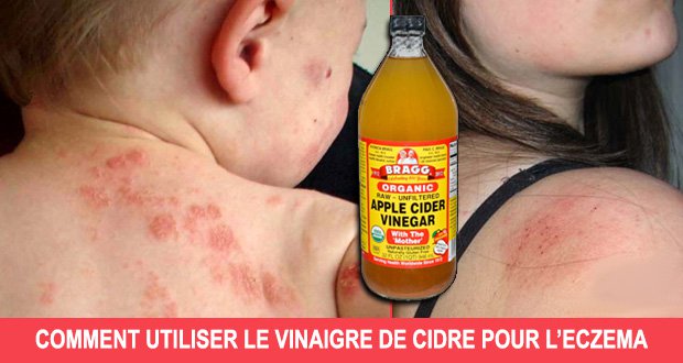 Comment soulagez l’eczéma avec le vinaigre de cidre ?