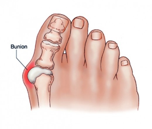 Comment se débarrasser des oignons aux pieds et des douleurs articulaires