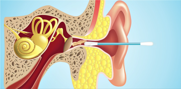 Pourquoi vous ne devriez jamais utiliser des cotons-tiges pour nettoyer vos oreilles