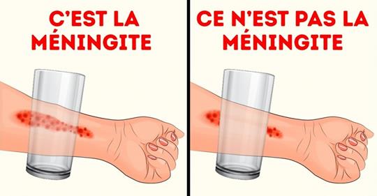 Les parents ne devraient pas ignorer ces 8 symptômes de la méningite