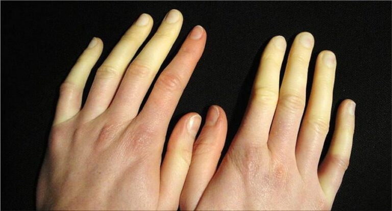 Maladie de Raynaud : se soigner naturellement avec des plantes