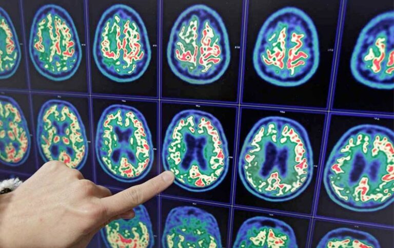 Un test pourrait détecter la maladie d’Alzheimer 20 ans avant qu’elle ne se déclare