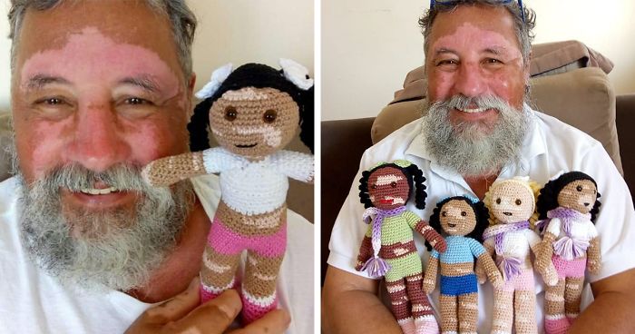 Il fabrique des poupées à la peau bicolore pour les enfants atteints de vitiligo